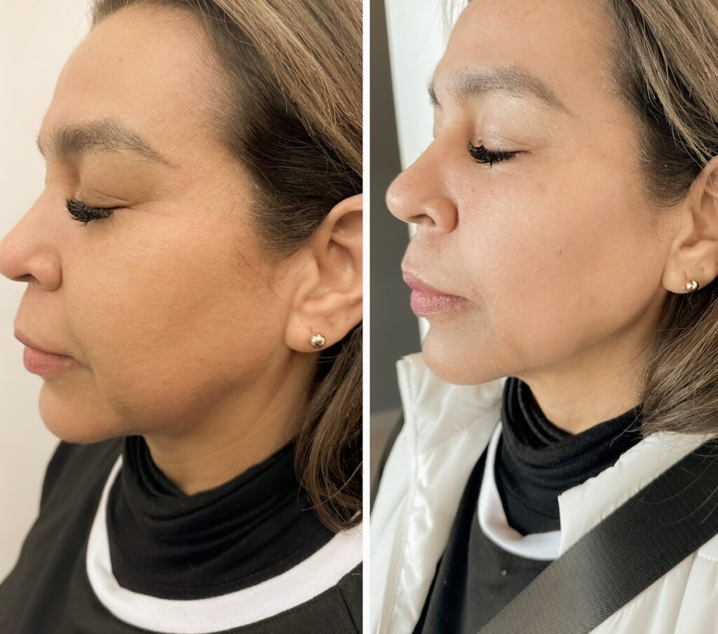 Before and after pictures of a jaw filler procedure.