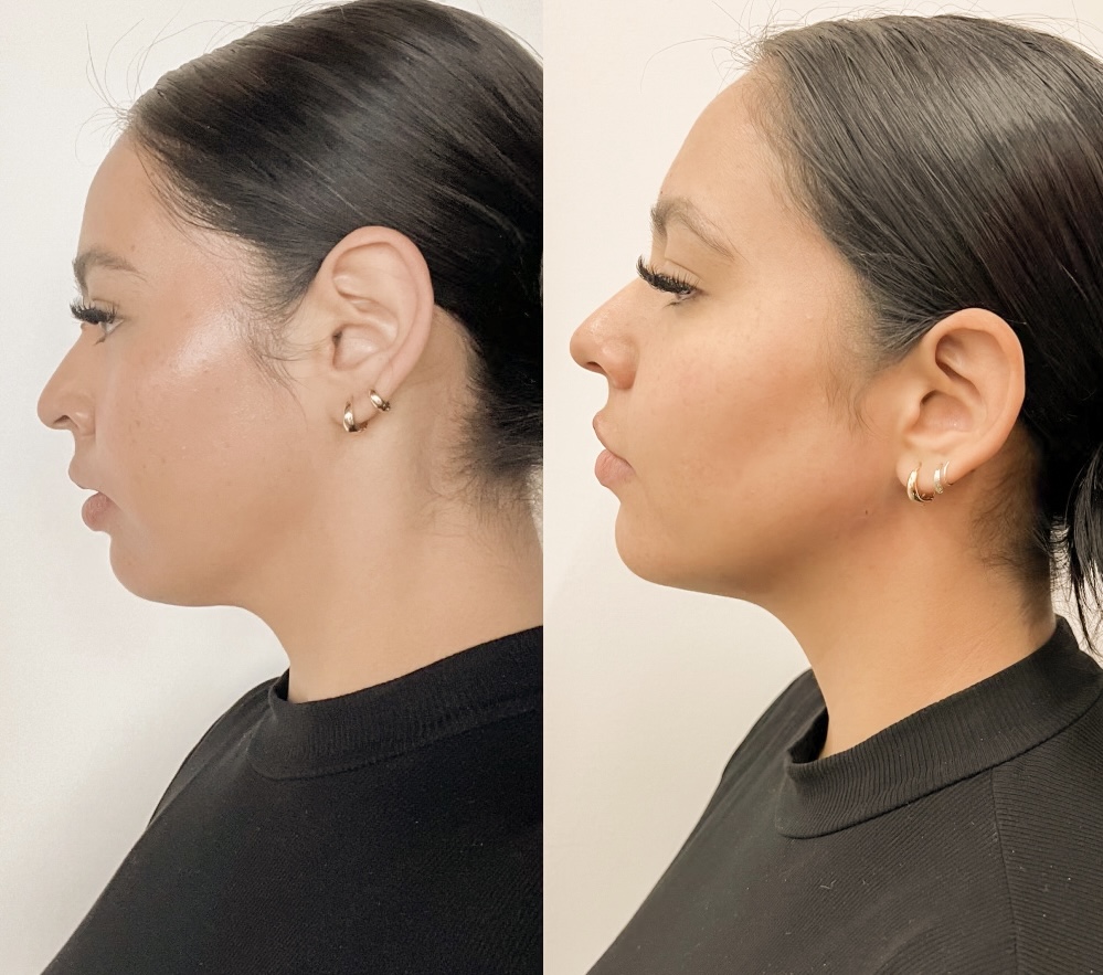 Before and after pictures of a jaw filler procedure.