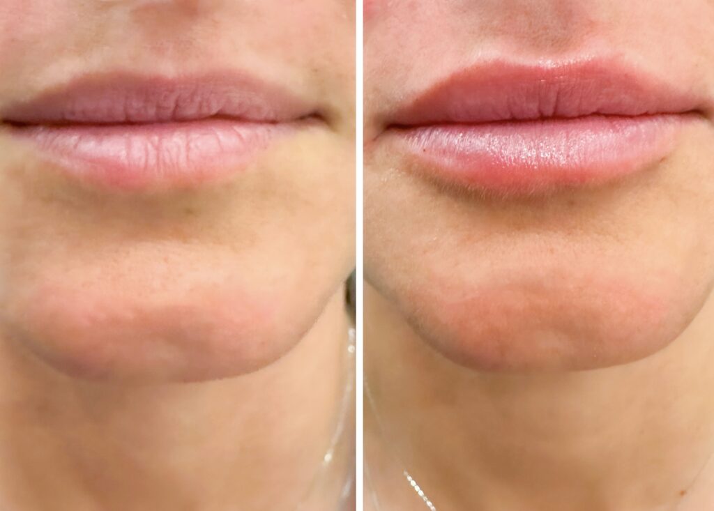 Before and after pictures of a lip filler procedure.